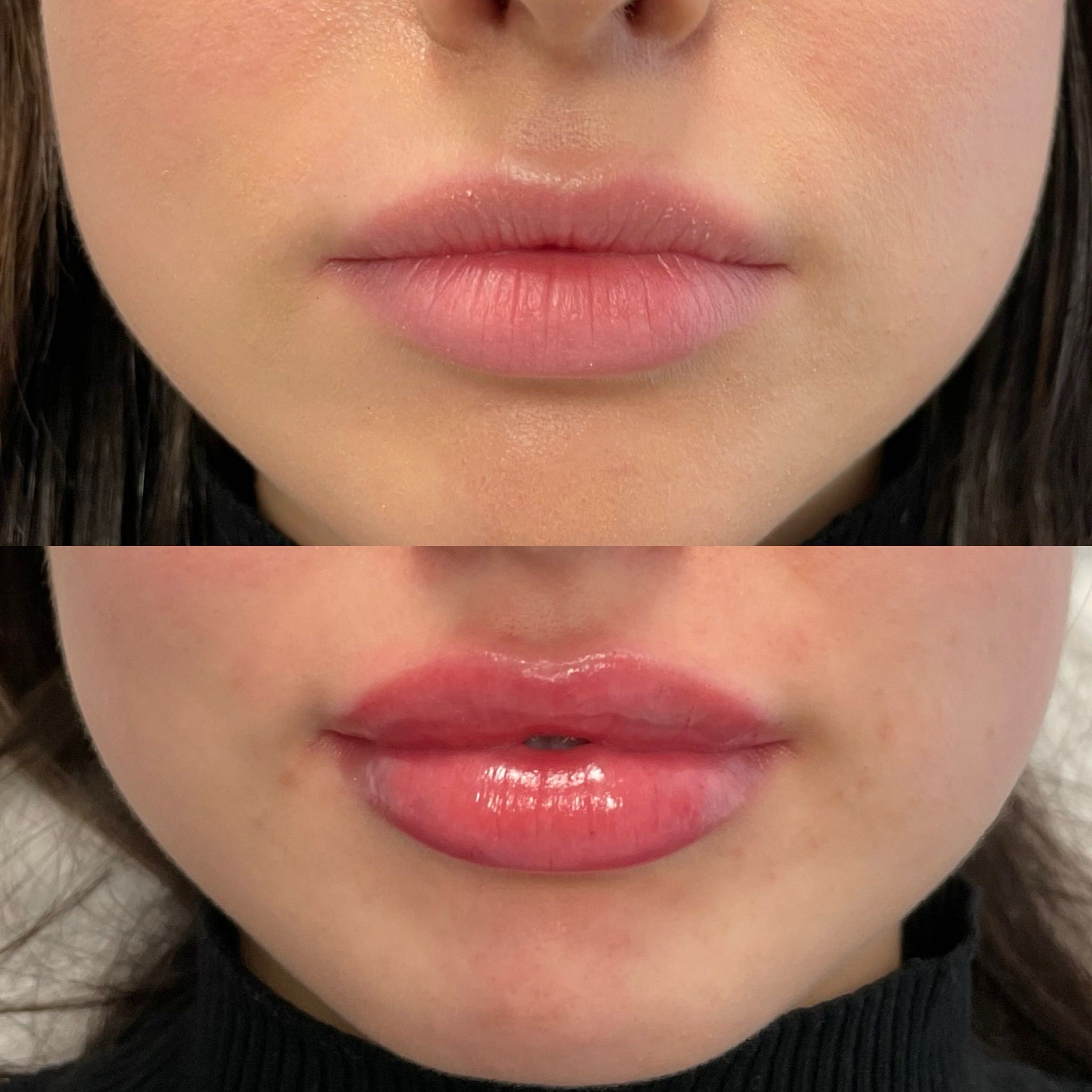 Natural Lip Filler in London: Elegant Lip Enhancement Without Excess