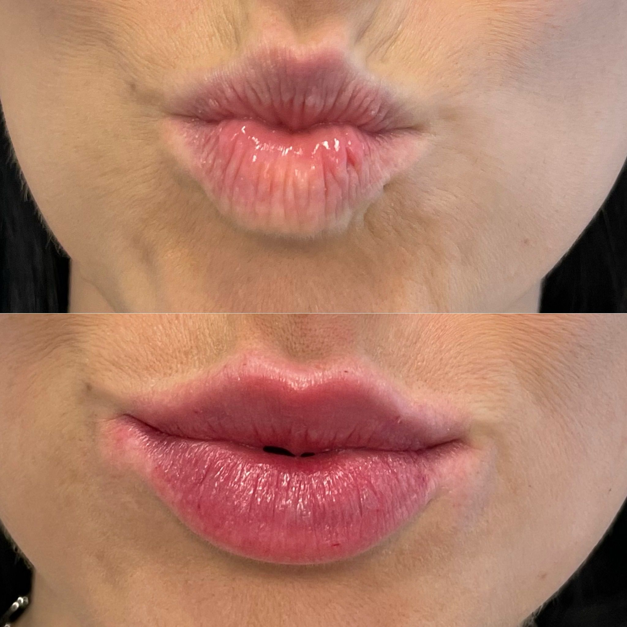 Natural Lip Filler in London: Elegant Lip Enhancement Without Excess