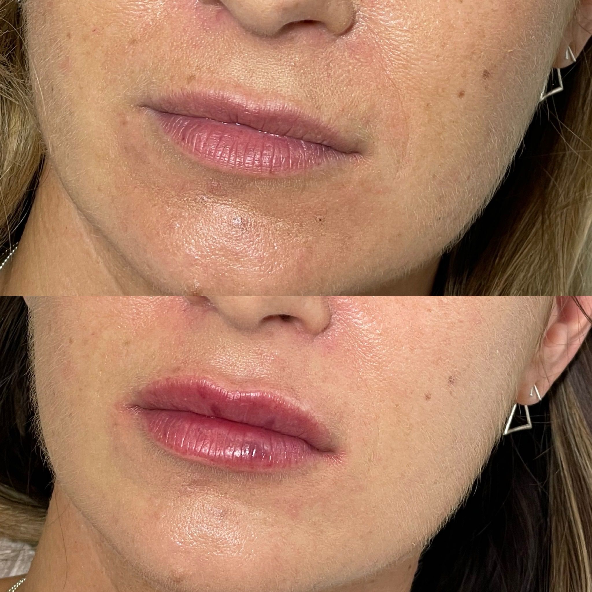 Natural Lip Filler in London: Elegant Lip Enhancement Without Excess